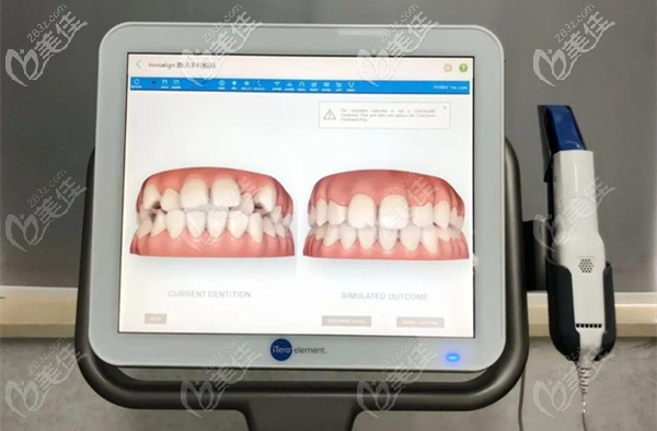 隐适美口腔扫描仪