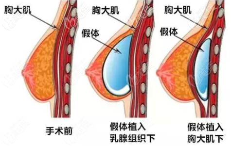 假体隆胸 假体隆胸