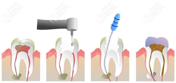 牙齿正畸中有蛀牙可以做根管治疗吗