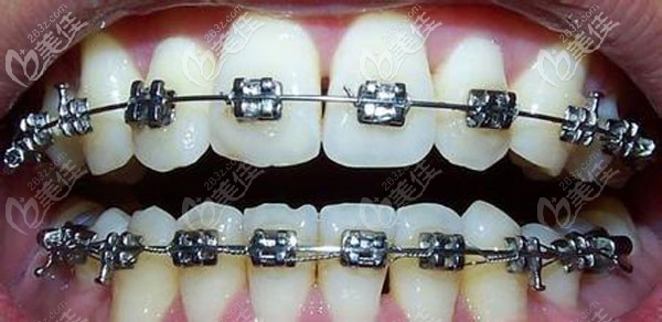 牙齿正畸中有蛀牙该怎么办，还能治疗吗