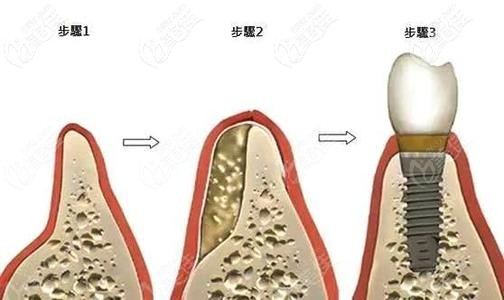 牙槽骨填充骨粉做种植牙