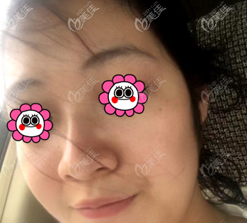 做M22光子嫩肤前 做M22光子嫩肤前