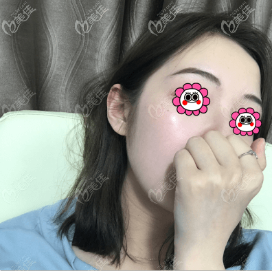 做光子嫩肤一个月了? 做光子嫩肤一个月了?