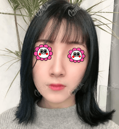 M22光子嫩肤后肌肤紧致有弹性 M22光子嫩肤后肌肤紧致有弹性