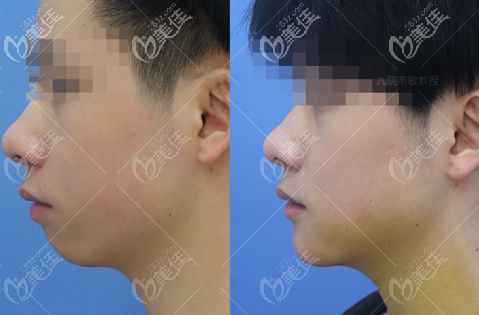 一个走心的下颏成型手术经历过程包含对比照片和费用