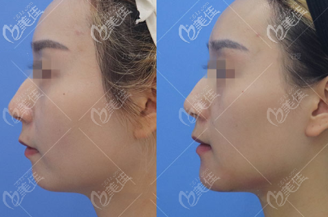 一个走心的下颏成型手术经历过程包含对比照片和费用