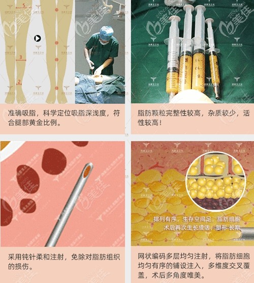 北京润美玉之光O型腿矫正过程