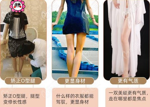 北京润美玉之光O型腿脂肪填充案例