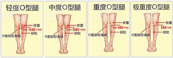 北京达美如艺矫正O型腿类型