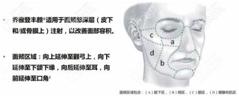 乔雅登丰颜适合注射填充的位置