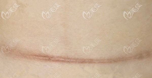  剖腹产疤痕增生11个月可以修复吗