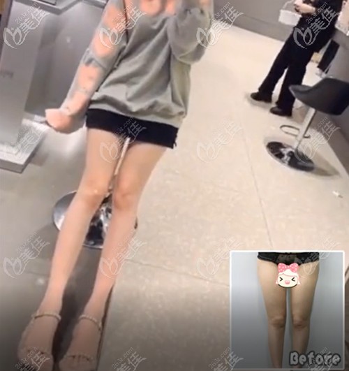 猜猜我找成都程红涛做的大小腿吸脂是多久恢复的?腿部吸脂恢复期短的原因在这