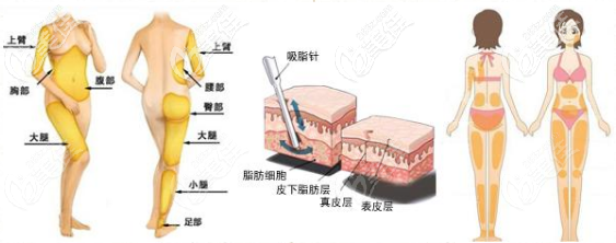 吸脂手术过程