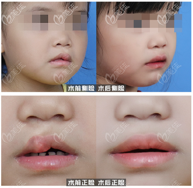 广州高尚余文林医生儿童唇腭裂修复案例