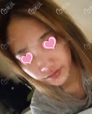 隆鼻术前照 隆鼻术前照