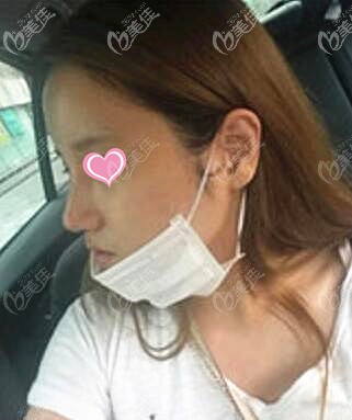 鼻综合术后一周拆线效果 鼻综合术后一周拆线效果