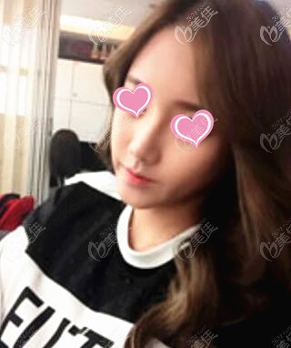 鼻综合1个月效果照 鼻综合1个月效果照