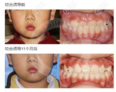 这是我家孩子6岁做地包天牙齿矫正的步骤和流程,戴的是罗慕咬合诱导矫正器