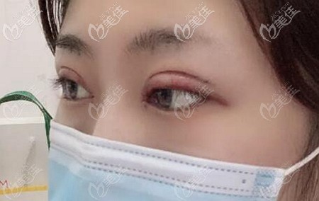 做眼综合后会有肿胀期