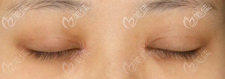 做完眼综合后疤痕不明显