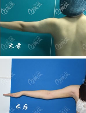 我手臂抽脂前后对比照片