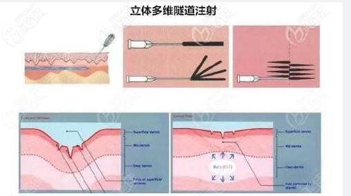 液态提升面部原理示意图 液态提升面部原理示意图