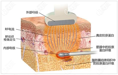 上海梵丽BTL腹部射频溶脂三十分钟就能见效