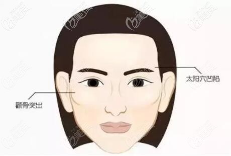 颧骨内推适合多大年龄做