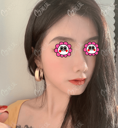 在北京做假体鼻综合半个月