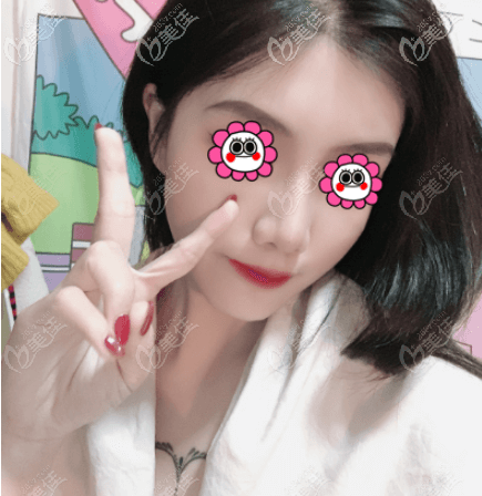 找王军做硅胶假体鼻综合没有后遗症感觉他做鼻子挺牛