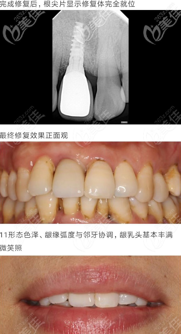 以色列ABT种植牙案例
