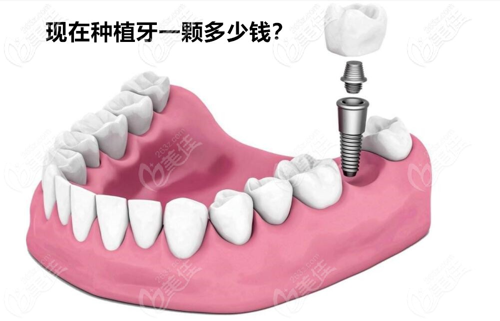 2021种植一颗牙多少钱 2021种植一颗牙多少钱