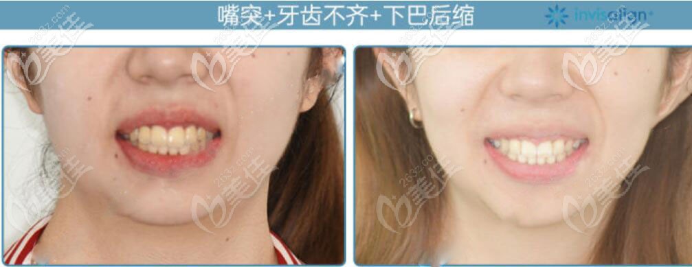 牙齿矫正前后对比照 牙齿矫正前后对比照