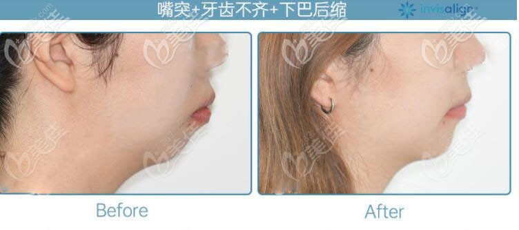 侧脸变化图 侧脸变化图