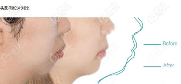 来评价:成都马泷齿科用隐适美牙套治疗骨性下巴后缩的效果好吗？