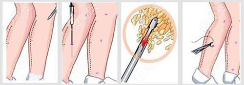 吸脂部位的伤口部位