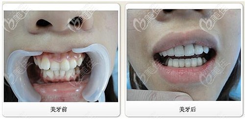 国产金属自锁牙齿矫正案例