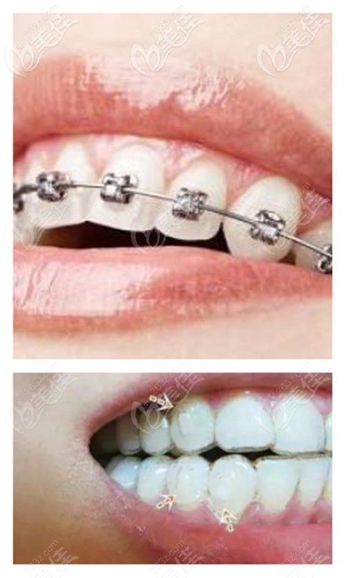 开封优尚牙齿矫正价格表