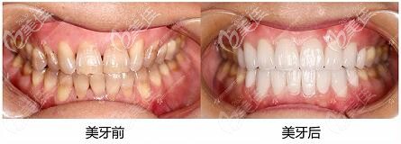 沈阳百嘉丽口腔韩国水晶贴面真人对比照