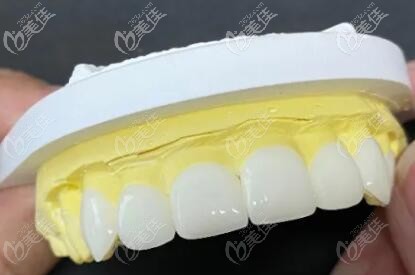 牙齿贴面改善牙齿问题