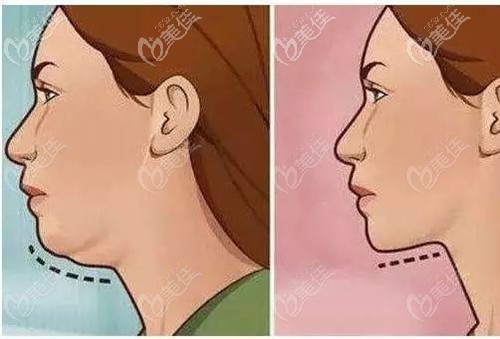 下颌缘松弛怎么提升紧致