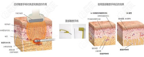 双下巴做黄金微雕吸脂过程