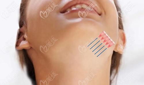 埋线提升下颌缘技术