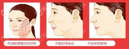 埋线提升下颌缘效果