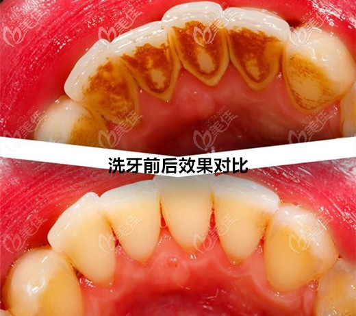 洗牙费用100和300的区别