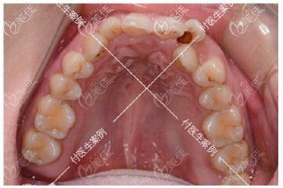 牙齿矫正前上牙效果