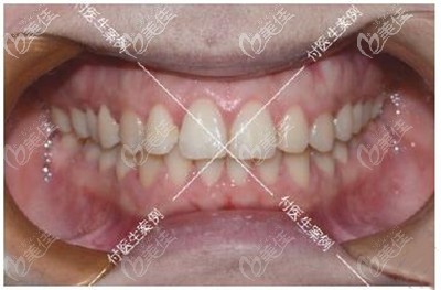 深覆合牙齿矫正前后牙齿效果对比
