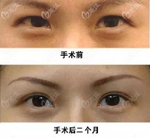 高亮全切双眼皮案例 高亮全切双眼皮案例