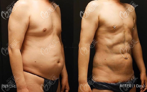 韩国丽迪安5D腰腹吸脂真人照片 韩国丽迪安5D腰腹吸脂真人照片