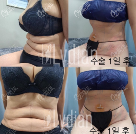 安敬天5D脂肪雕刻术实例图 安敬天5D脂肪雕刻术实例图